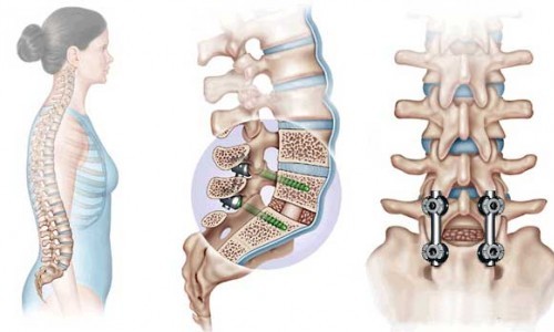 Индикации и противопоказания за транспедикулярно фиксиране на гръбначния стълб и признаци за рехабилитация
