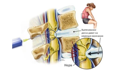Показания, противопоказания и последствия от лечебна блокада на гръбначния стълб