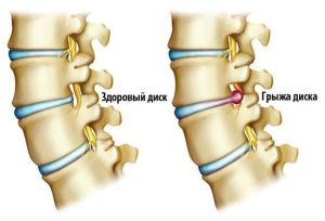 Лечение на гръбначния стълб и възстановяване от заболявания без хирургия и хирургия