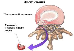 Дисцектомия - как и защо е хирургично отстраняване на междузобедрения диск