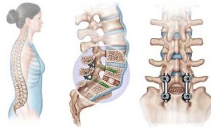 Защо и как се извършва транспецикуларното фиксиране на гръбначния стълб
