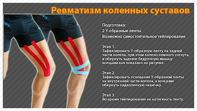 Потупване на колянната става като алтернатива на конвенционалната превръзка