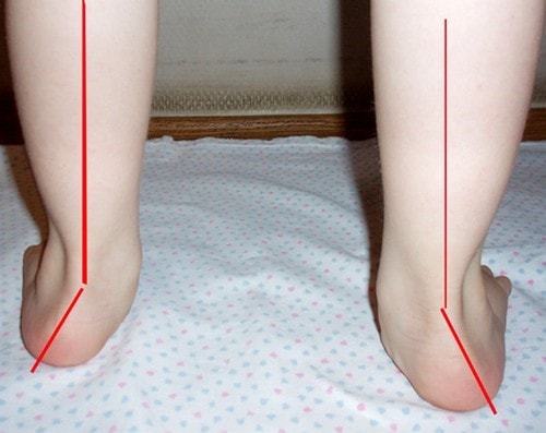 Деформация на крака при деца