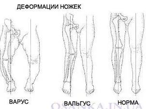 Деформация на крака при деца