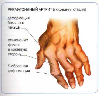 Фолиева киселина при ревматоиден артрит