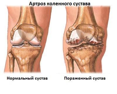 Остеоартрит на колянната става