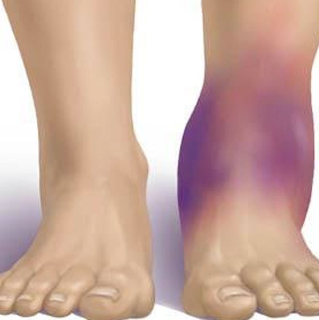 Болка в арката на краката - причини