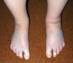 Болка в арката на краката - причини