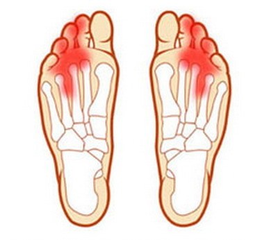 Болка под пръстите на краката - причини и лечение