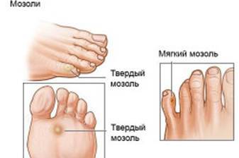 Запечатване на стъпалото на краката - причини и лечение