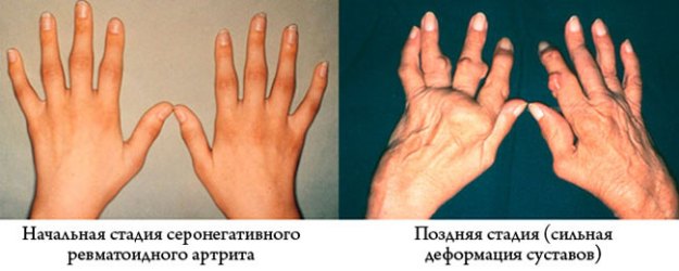 Серонегативен ревматоиден артрит