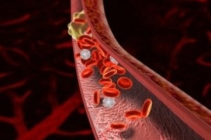 Тромбоза на артериите на долните крайници