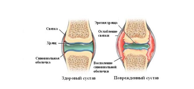 Причини за болка в коленете на жената