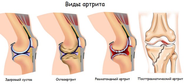Ревматоиден артрит и болка в краката | Компетентно за здравето на Крем Move&Flex в България