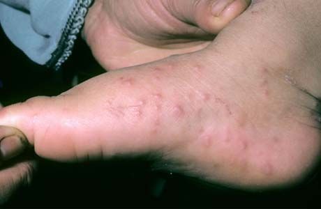 Алергии на краката на детето