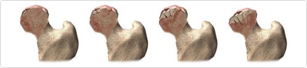 Асептична некроза на главата на бедрената кост