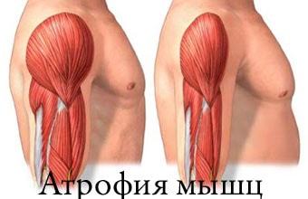 Атрофия на мускулите