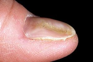 Деформация на ноктите по краката - причини и лечение