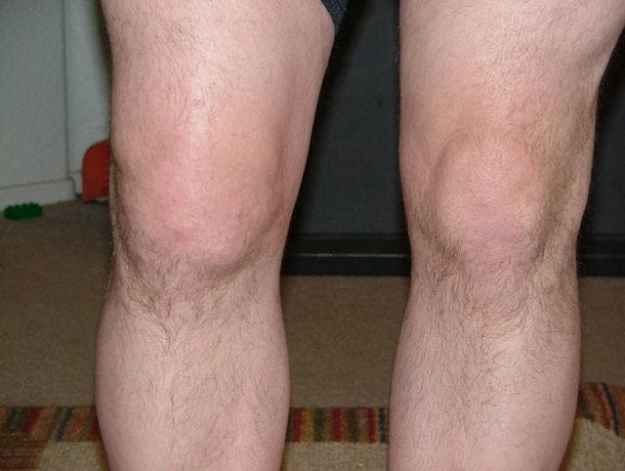 В течността на коляното - причини и лечение