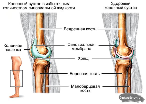 В течността на коляното - причини и лечение