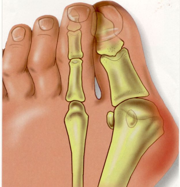 Кракът боли под пръстите при ходене