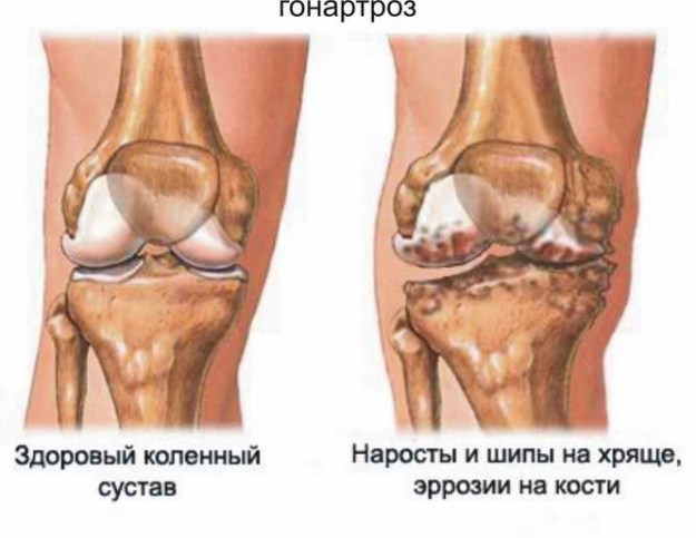 Възпалени колене - причини и лечение