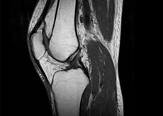 Лиганоза на колянната става