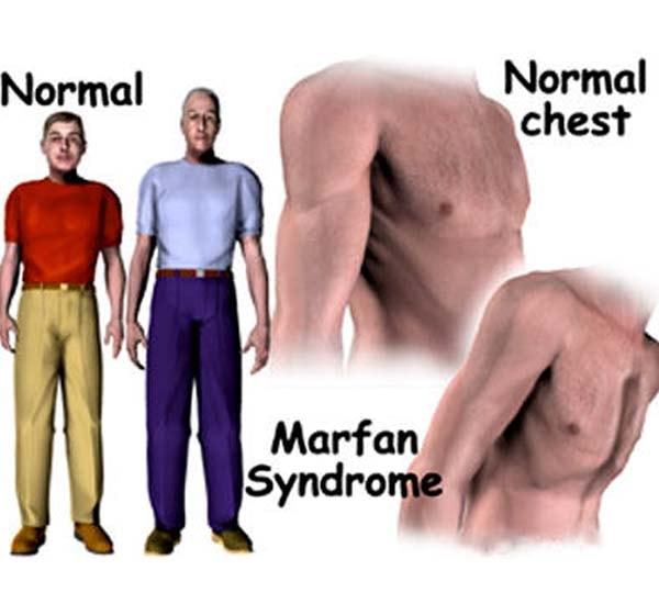 синдром на марфан