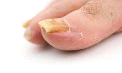 Псориазис на ноктите - видове и лечение