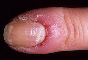 Псориазис на ноктите - видове и лечение