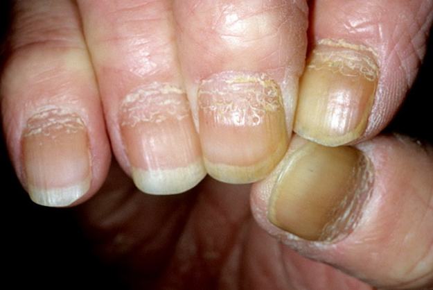 Проблеми при ноктите при псориазис