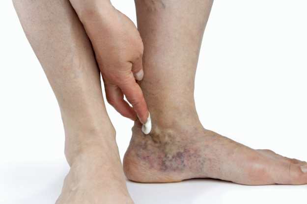 Оклузия на краката: симптоми и лечение