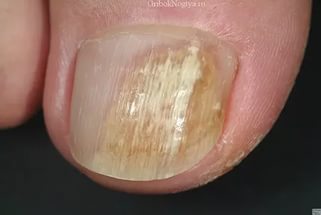 Onychomadesis - жълти нокти на краката