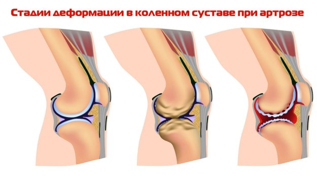 Остеохондроза на колянната става