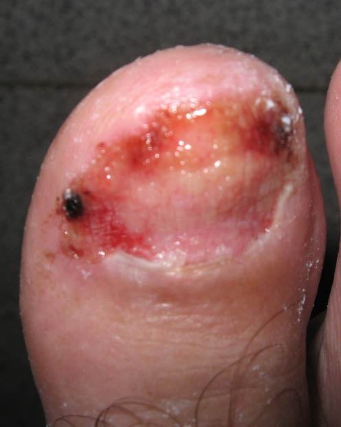 Възстановяване на нокътя на нокътя след отстраняване