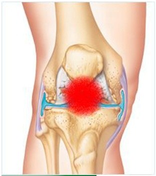 Соли - отлагане в колянната става