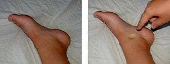 Оток на краката след раждане или цезарово сечение