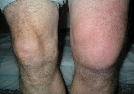 Синовитит на колянната става
