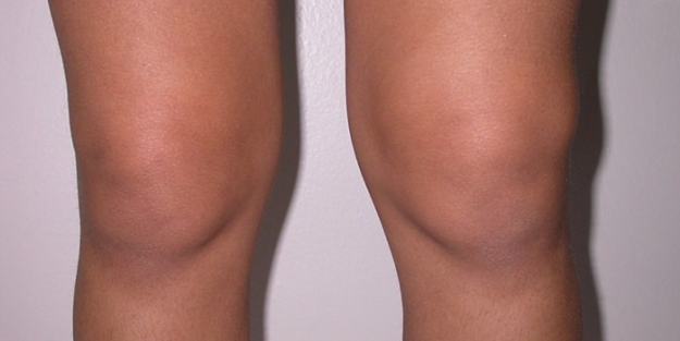 Неметни причини за коляното