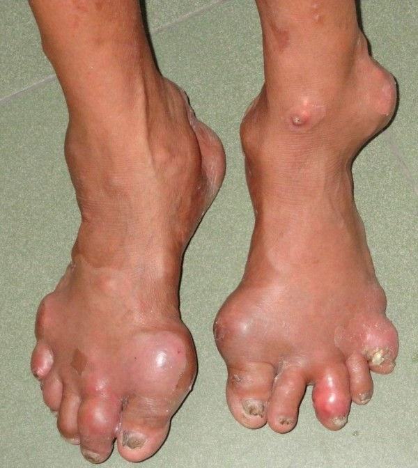 Средният пръст на крака боли