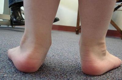 Валгус деформации на краката при деца