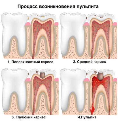 Как мога да излекувам пулпит на зъба?